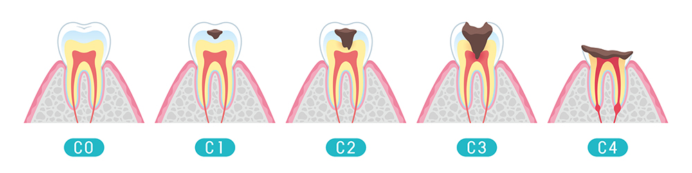虫歯の進行と治療法