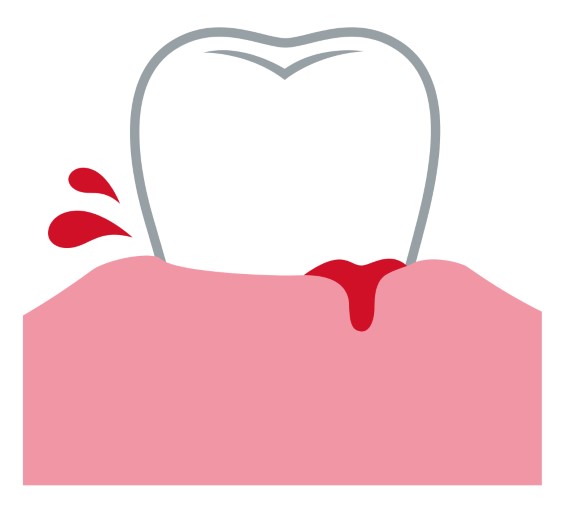 何もしていないのに歯茎から出血、放っていませんか？