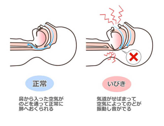 睡眠中に何度も呼吸が止まるのが睡眠時無呼吸症候群です