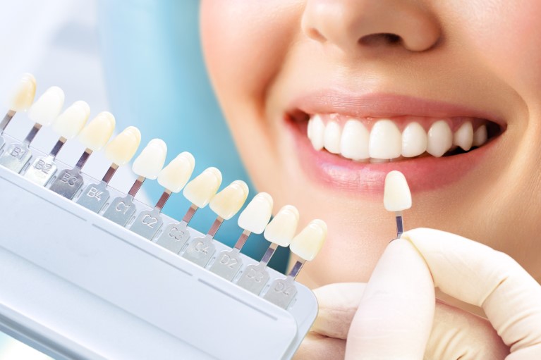 銀歯より保険治療よりセラミック治療が優秀！？