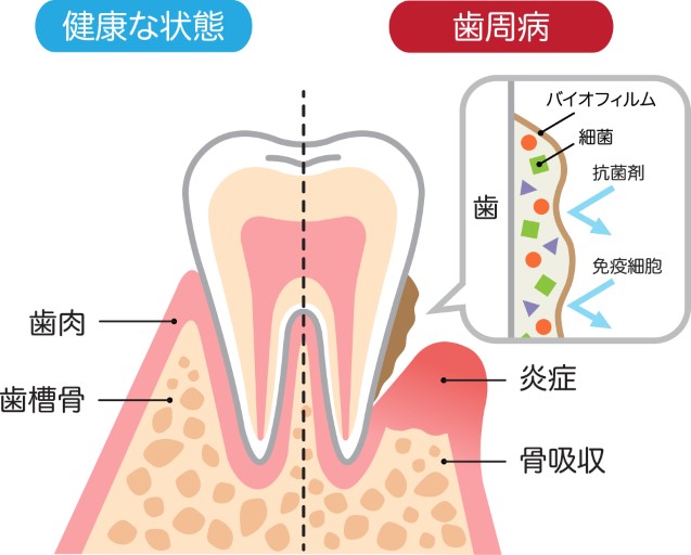 奥歯の歯茎が腫れる・痛いときに考えられる原因