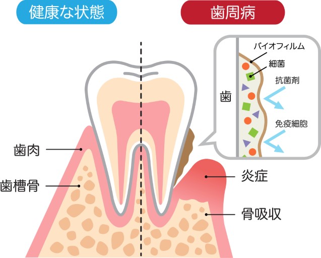 歯周病