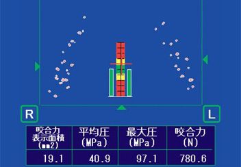 咬合圧測定システム