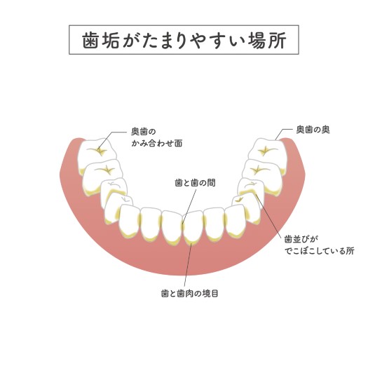 細菌（プラーク・歯石）