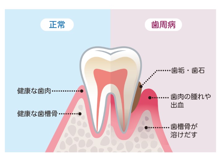 歯周病とは