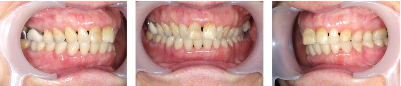 歯がボロボロ　症例3（アフター）