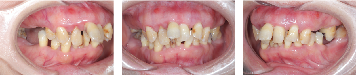 歯がボロボロ　症例1（ビフォー）