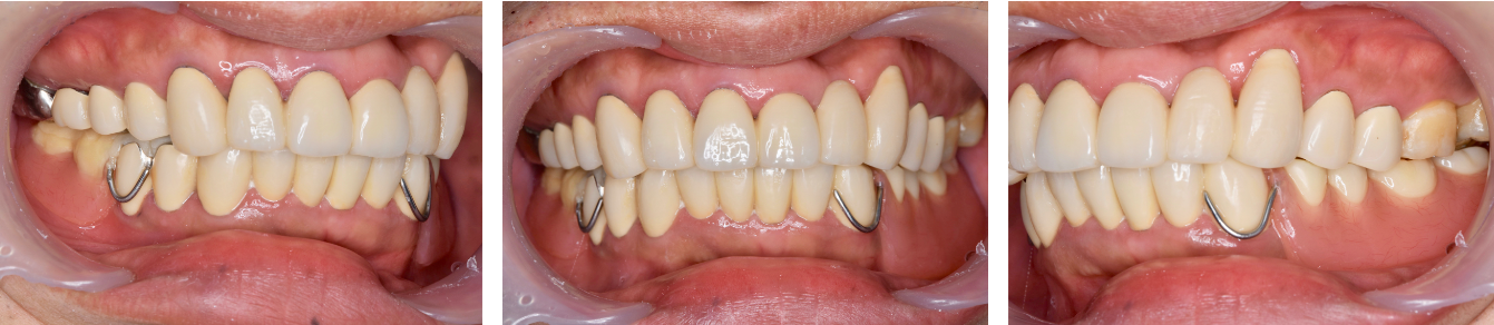 歯がボロボロ　症例2（アフター）