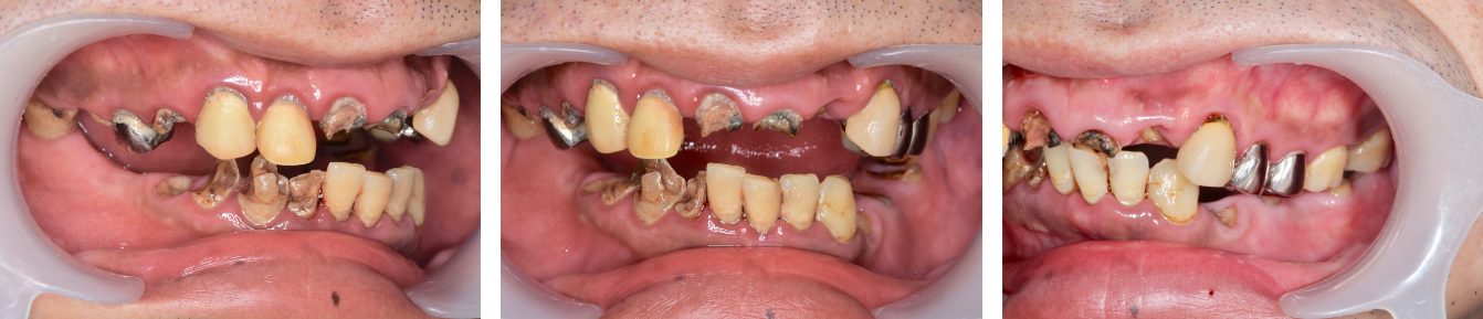 歯がボロボロ　症例2（ビフォー）
