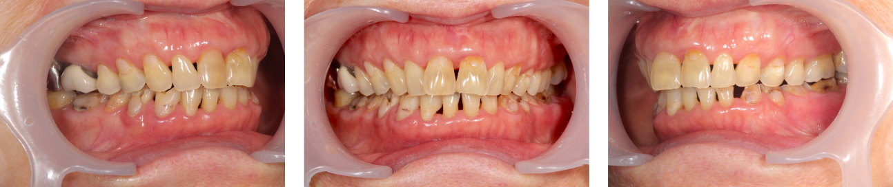 歯がボロボロ　症例3（ビフォー）