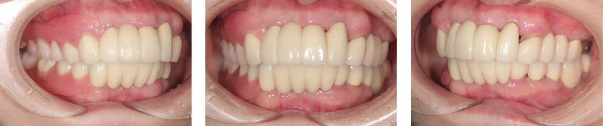 歯がボロボロ　症例1（アフター）